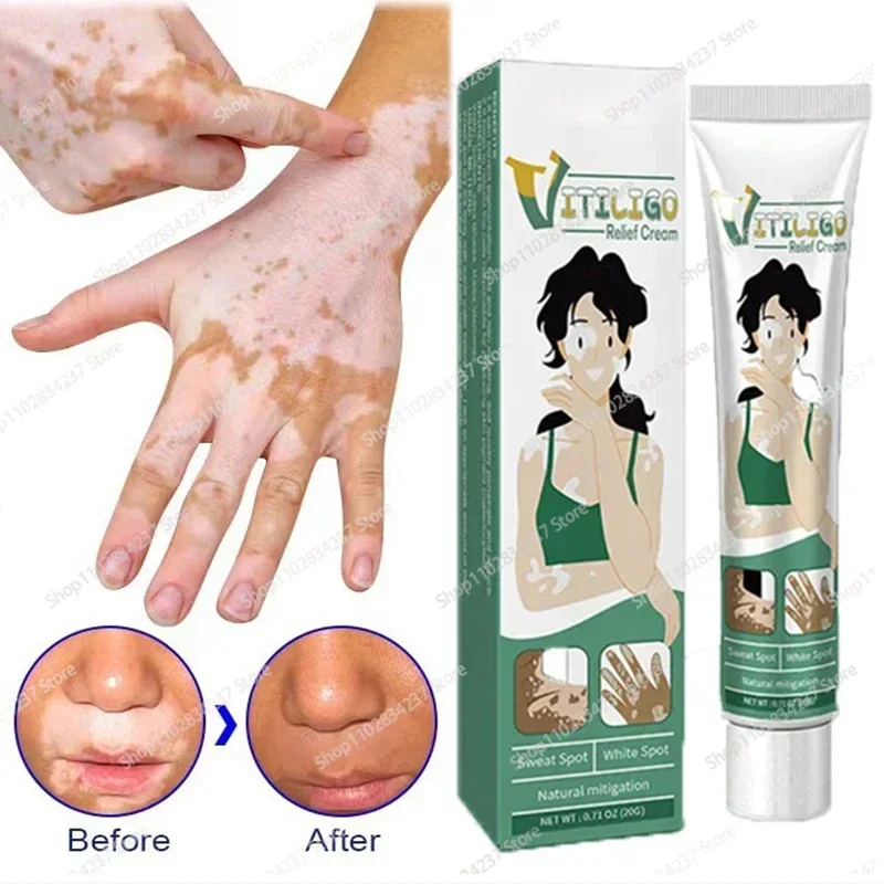 

Eliminate Vitiligo Cream Relief Spray Skin White Spot Removal Ointment 0924