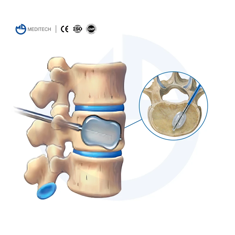 MEDITECH Joint Bone Cement Beste kwaliteit en prijs Chirurgische Bone Cement bone cement injector