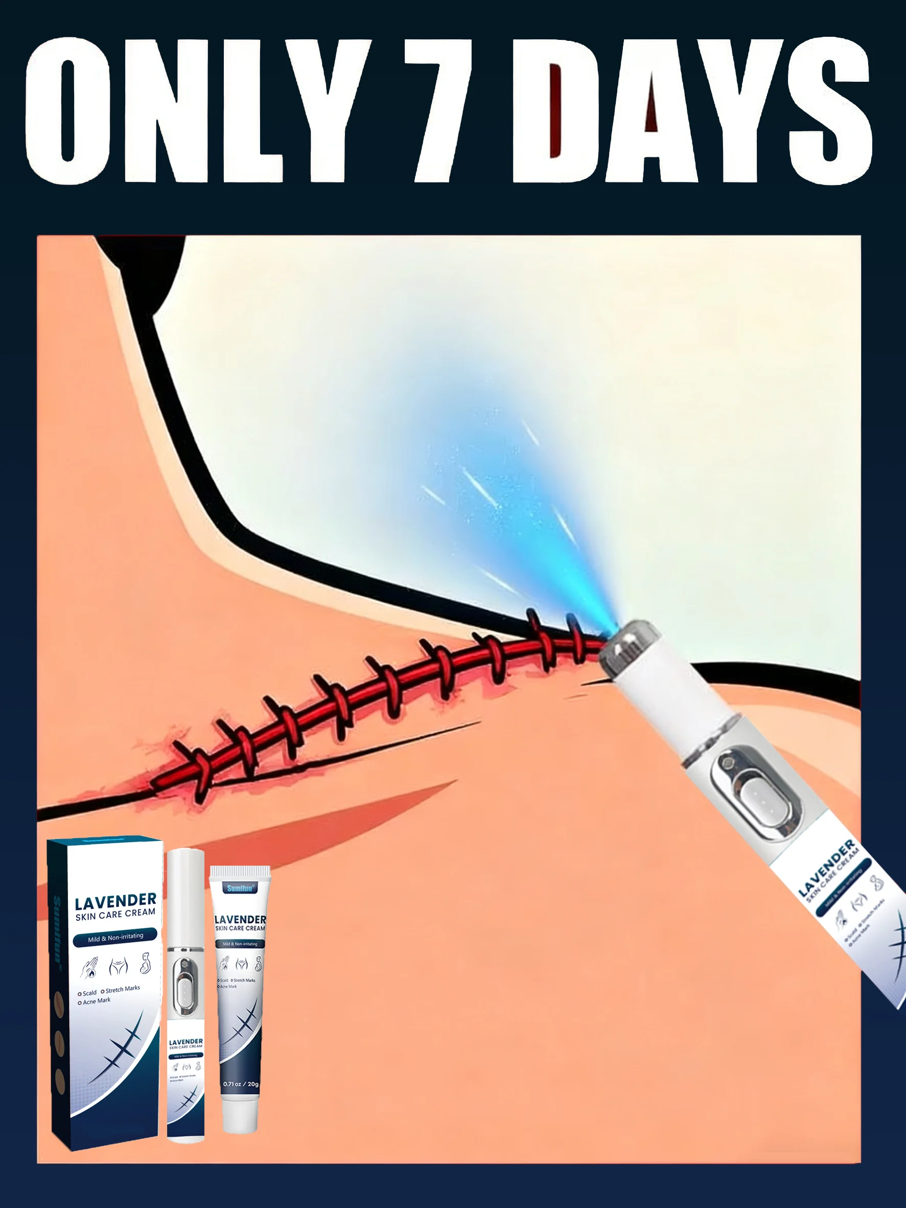 

Стирайте растяжки беременности: усовершенствованная технология лазерной ручки