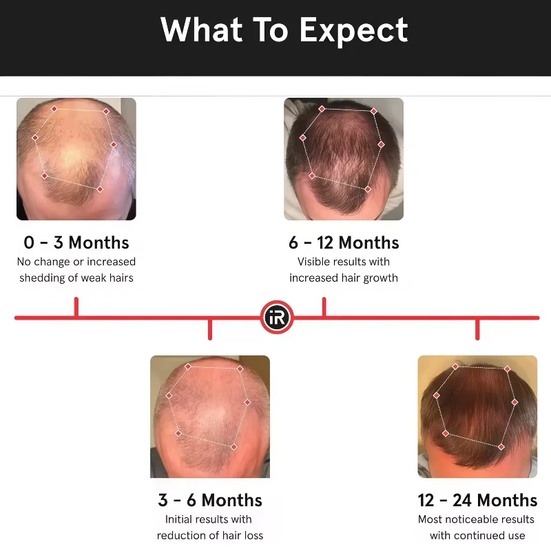 

Медицинская шапочка для роста волос LLLT, беспроводная терапия красным светом и 80 лазерными диодами для решение для истонченных волос