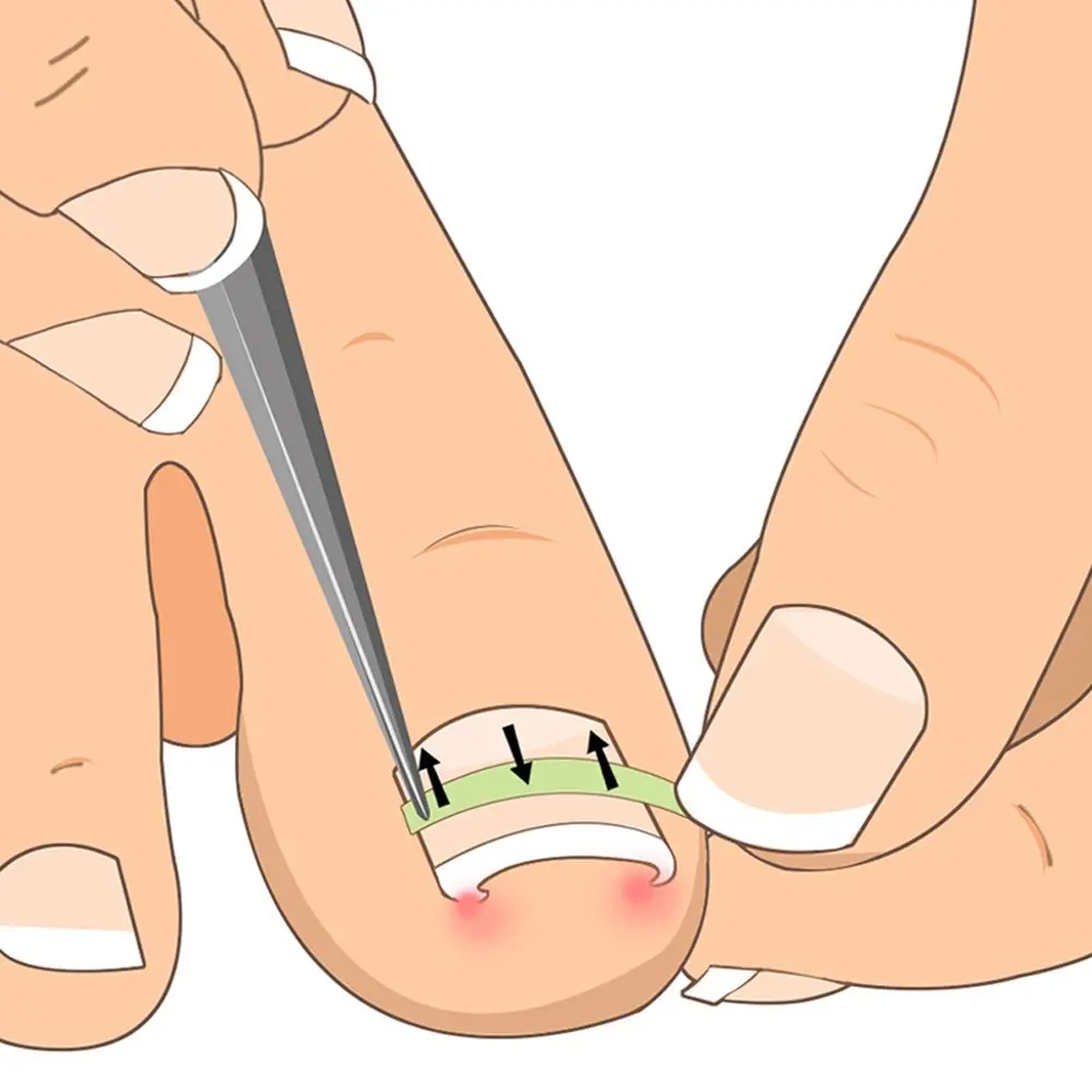 PARON-Outil de pédicure pour ongles incarnés, pince à redresser, attelle Bs incurvée, outil de paronyamitié optique, 10 pièces par bouteille