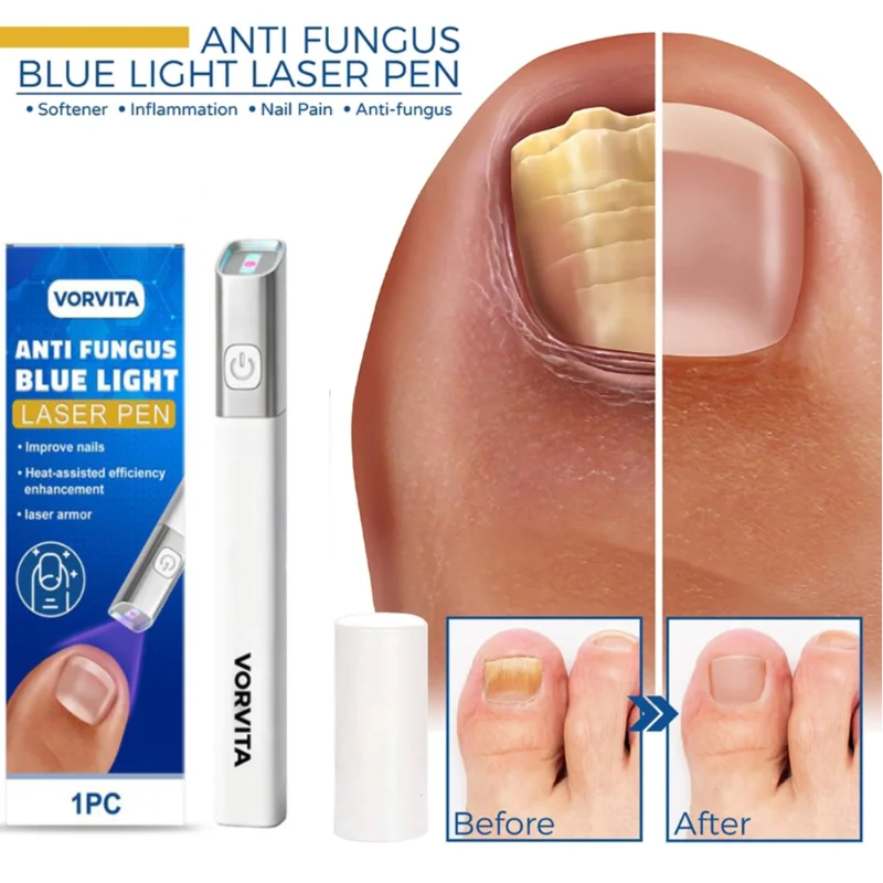 Nail Fungus Treatment Pen Anti-fungal Repair Pen Blue Light Laser Pen Paronychia Nail Onychomycosis Painless Removal Care Tool