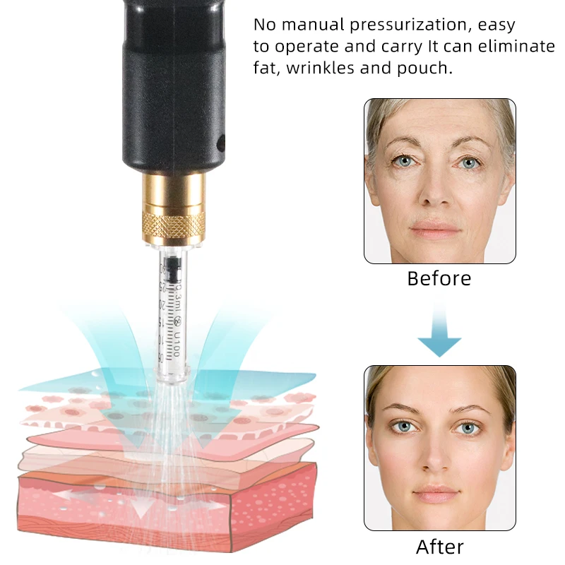 قلم حقن كهربائي بحمض الهيالورونيك ، طقم قلم شفاه احترافي ، ملء بدون إبرة ، ضباب مستمر #5