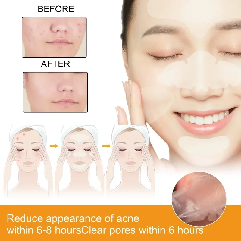 20pcs Pack Portable Hydrogel Facial Acne Patch Transparent Invisible Hydrogel Acne Patch Facial Care Concealer