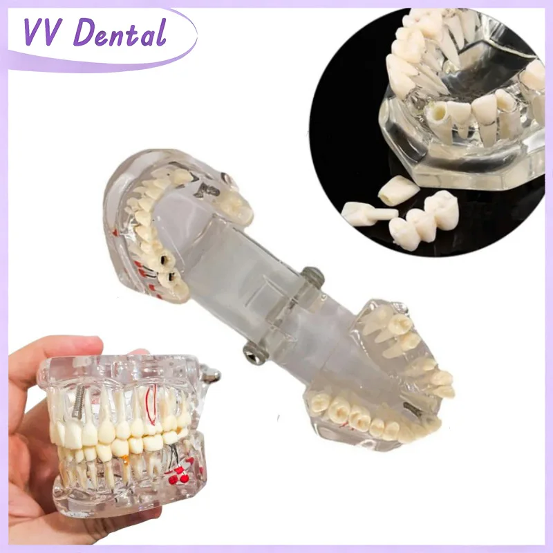 

Модель зубов VV Dental Pathology Typodont 1:1, стандартная демонстрационная образовательная модель для обучения/коммуникации между врачом и пациентом
