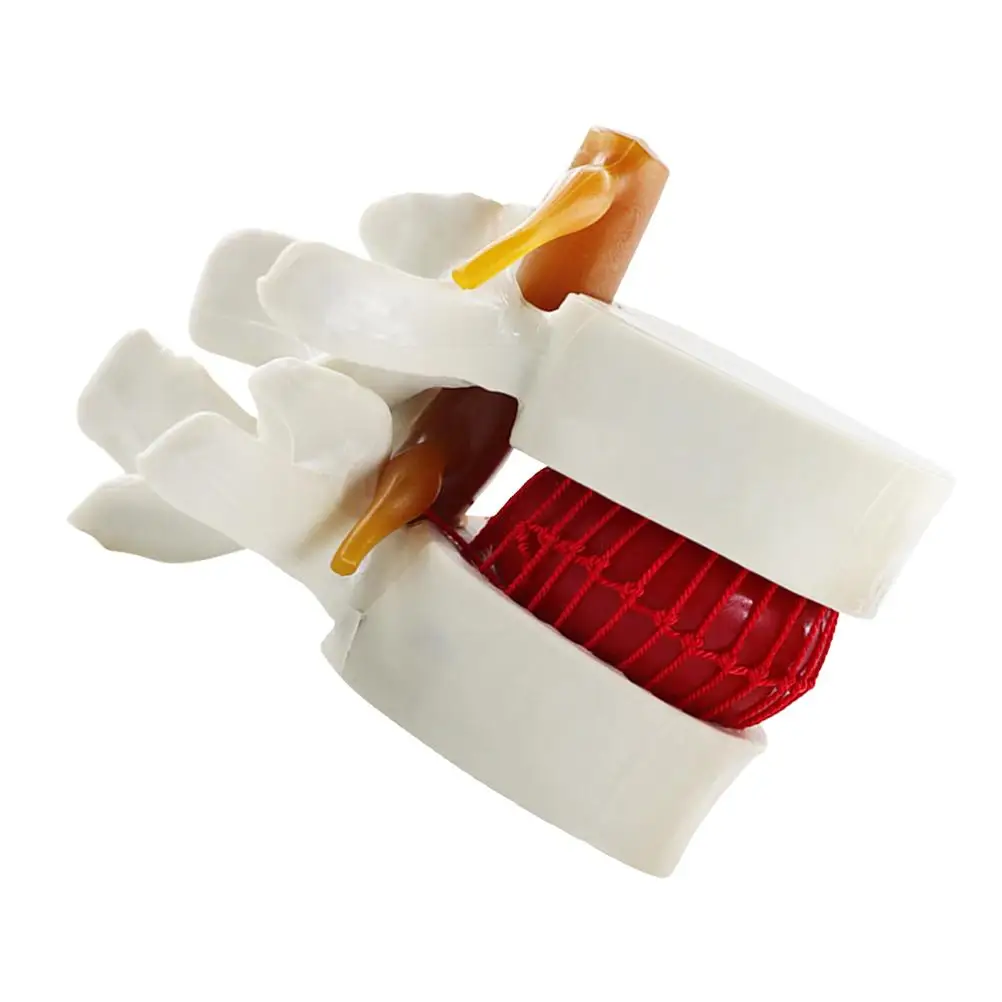 

PVC Lumbar Disc Herniation Model Realistic Shape Portable Teaching Medical School Hospital Research Anatomy Learning