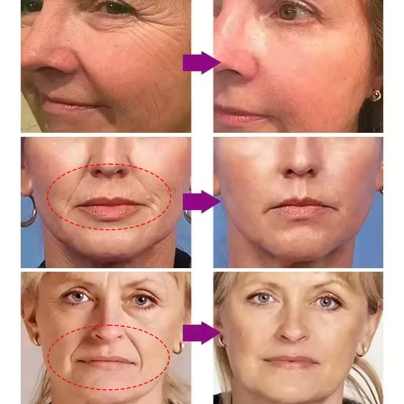 Patch Lipatan Nasolabial Mengandung Kolagen Asam Hialuronat Pengencang Kulit Memudarkan Garis Halus Masker Wajah Pelembab Dalam Anti Kerut