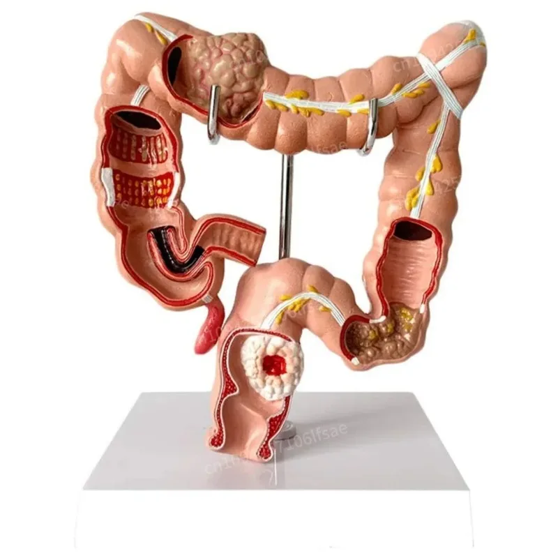 

Human Large Intestine Anatomical Model Visceral Lesion Model Colon Pathology Model Anatomical Anatomy Digestive System Display
