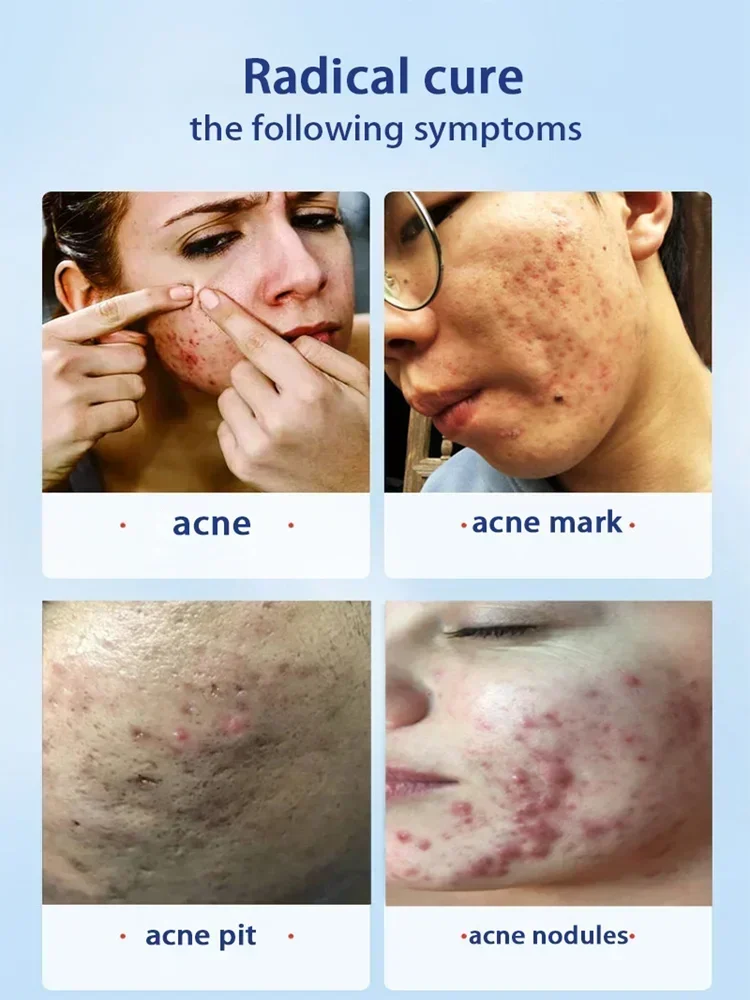 Ervas-Acne Tratamento Rosto Soro, Pimple Remover, Encolher Poros, Controle De Óleo, Cuidados Com A Pele