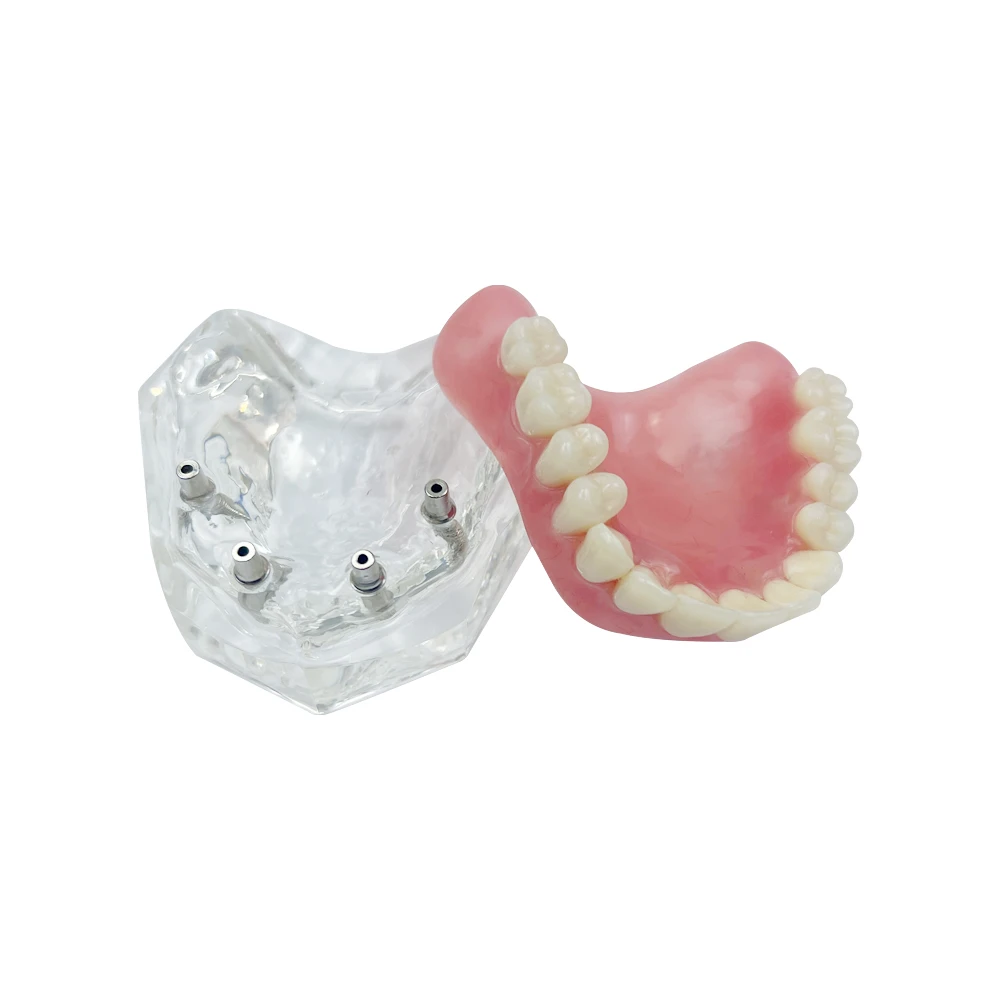 M6001 Dentes Dentais Modelo para Estudante Dentista, Modelos de Comunicação para Paciente, Overdenture, Odontologia, Maxila Superior, 4 Implantes