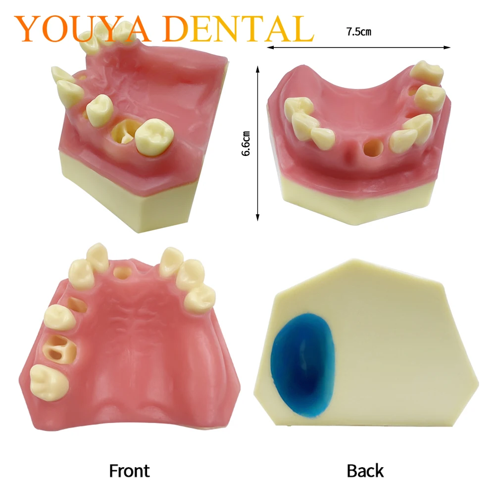 Dental Missing Tooth Dental Implant Teeth Model Student Teaching Training Aid Practice Model Dentist Studying Demonstration