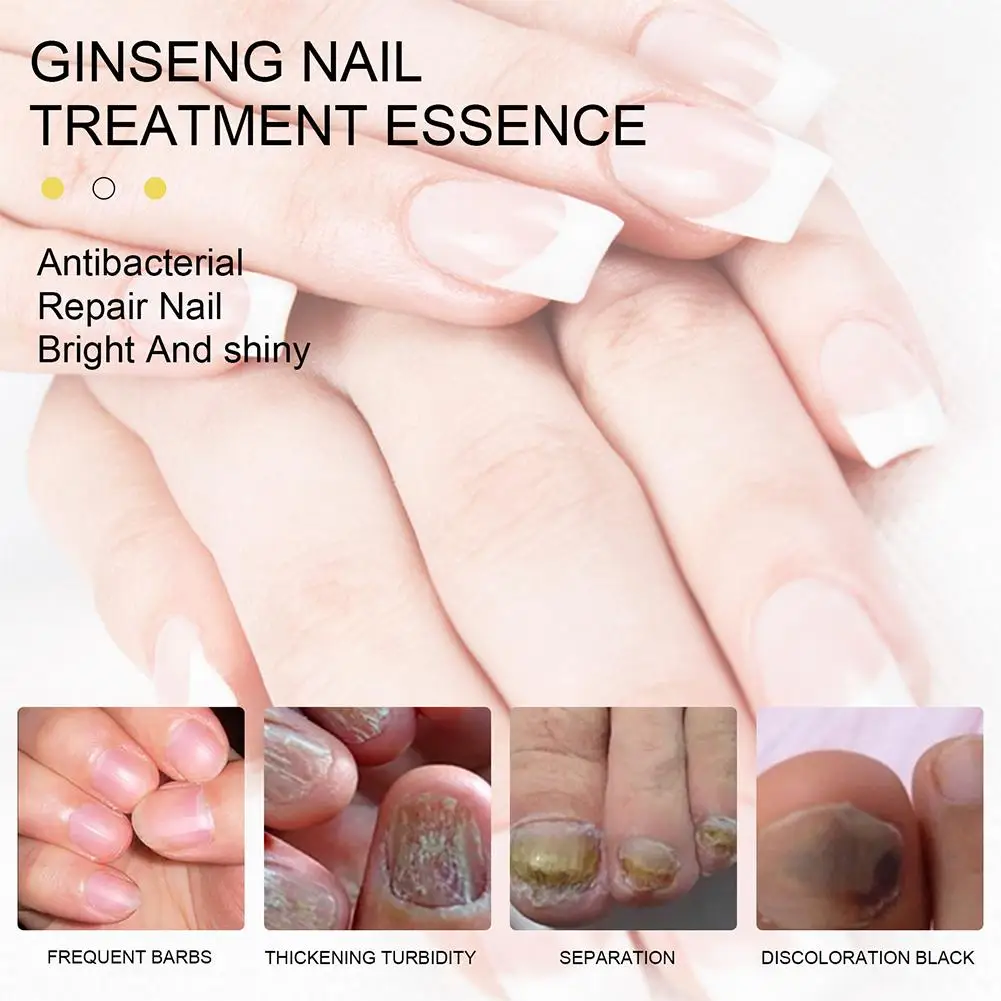 Nail Fungus Removal Cream Onychomycosis Fungal Nail Anti Nail Ointment Care Fungal Infection Treatment Feet Toe Paronychia H2D9