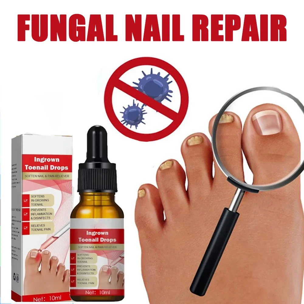

Nail Fungus Treatment Oil Fungal Treatment Feet Care Essence Anti Infection Paronychia Onychomycosis Ingrown Toenail