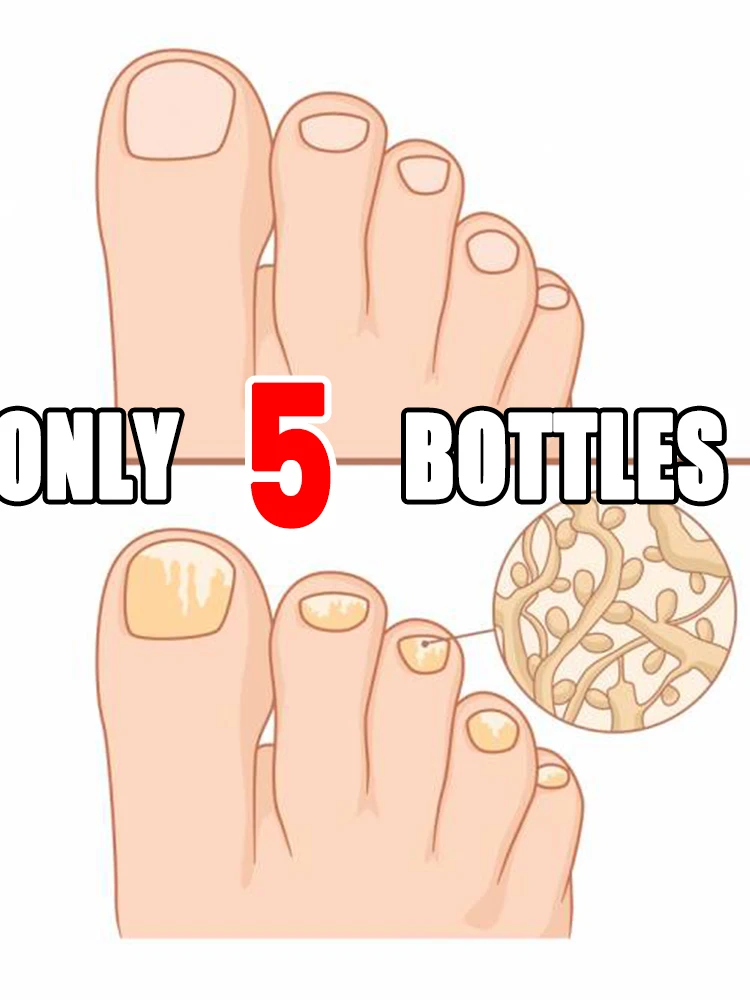 

2025 The latest technology blue laser eliminates fungi and restores healthy nails