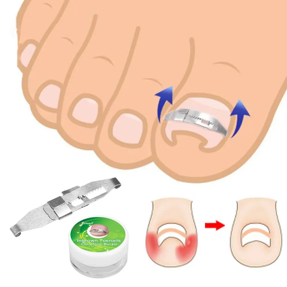 Effective Foot Health Care Paronychia Ingrown Toenail Straightener Pedicure Tools Correction