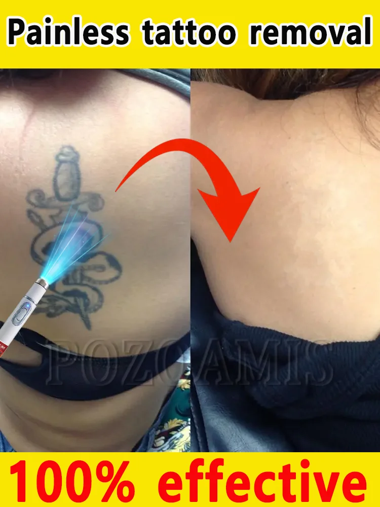 

Pigmentation can be quickly removed without leaving any trace.