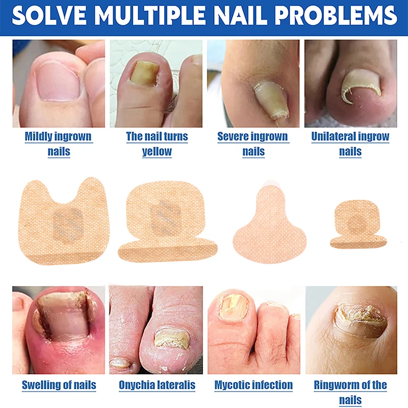 爪のケアパッチ,爪の修復パッチ,灰色の真菌の爪の肥厚,柔らかい爪囲炎治療,抗感染矯正ステッカー