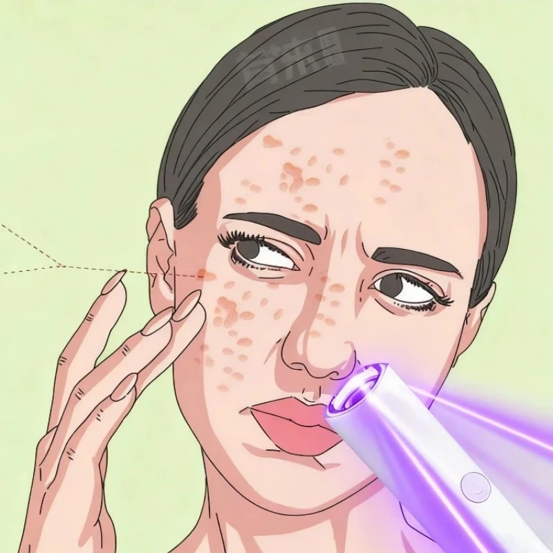 

Laser Plasma Pen Skin Tag Remover Tool ，very good