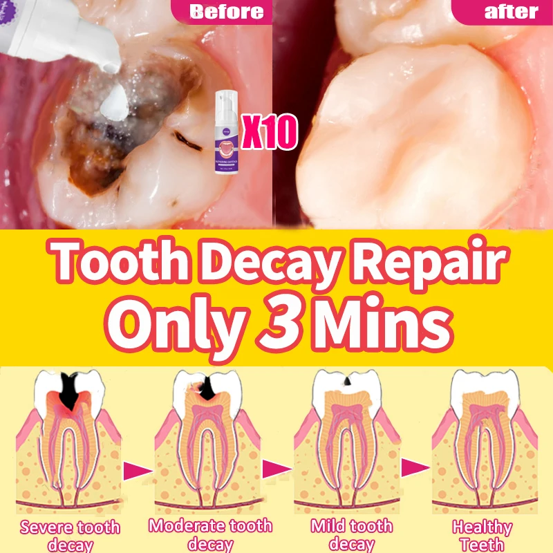 

Repair tooth decay, effectively whiten teeth, and prevent recurrence of tooth decay