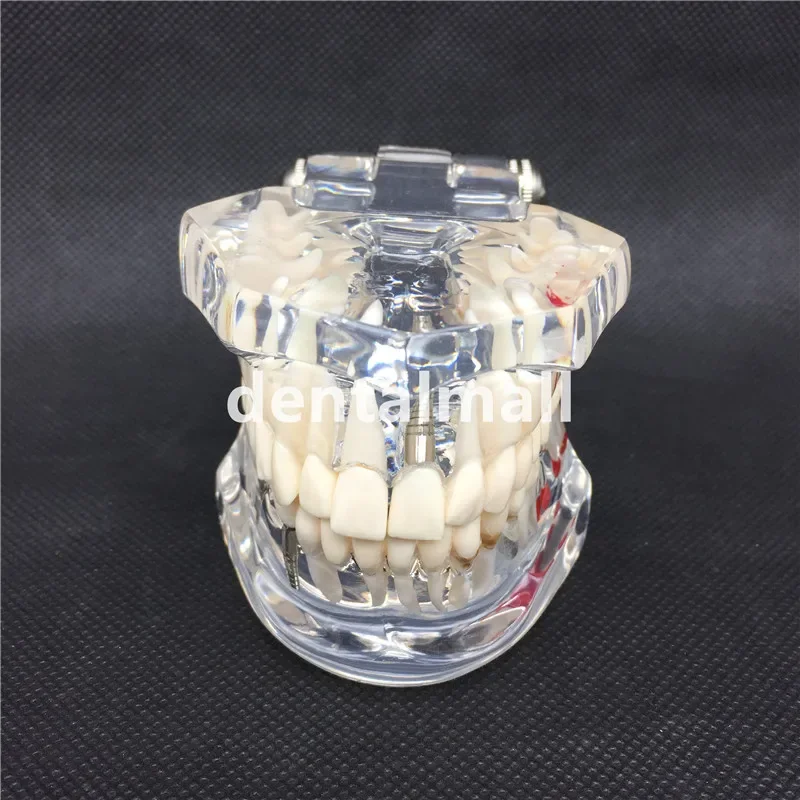 

Dental Implant Disease Teeth Model With Restoration Bridge Tooth Dentist For teaching