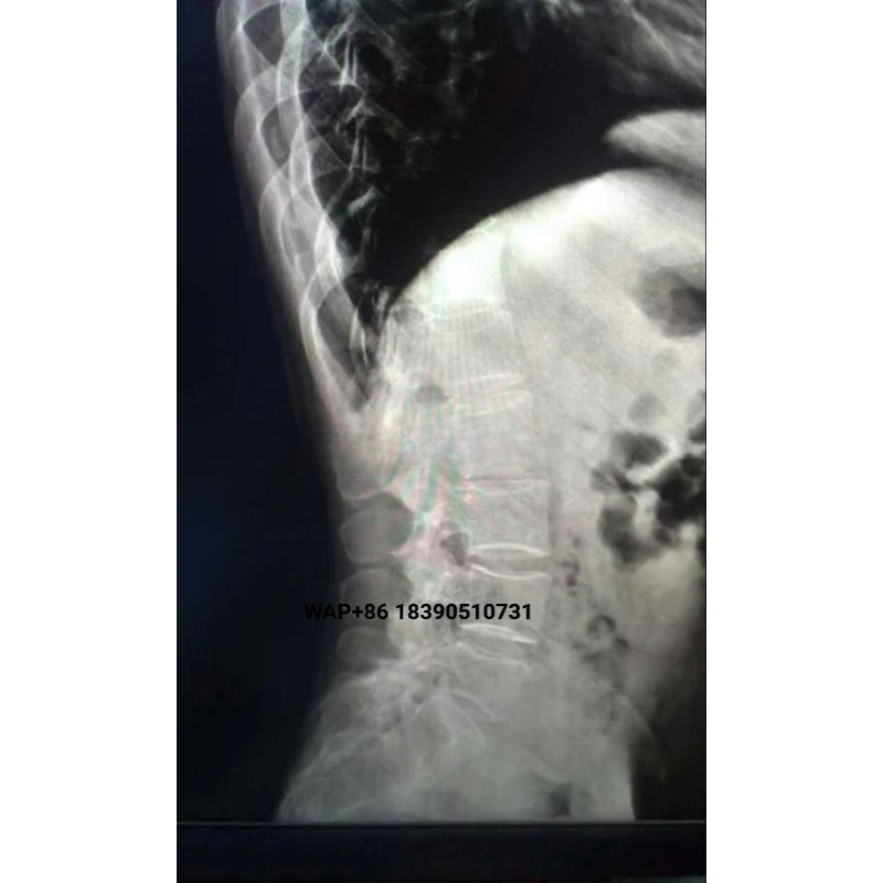 Promote the 3.5 kW 5kw mobile high-frequency X-ray C-arm plant for peripheral angiography
