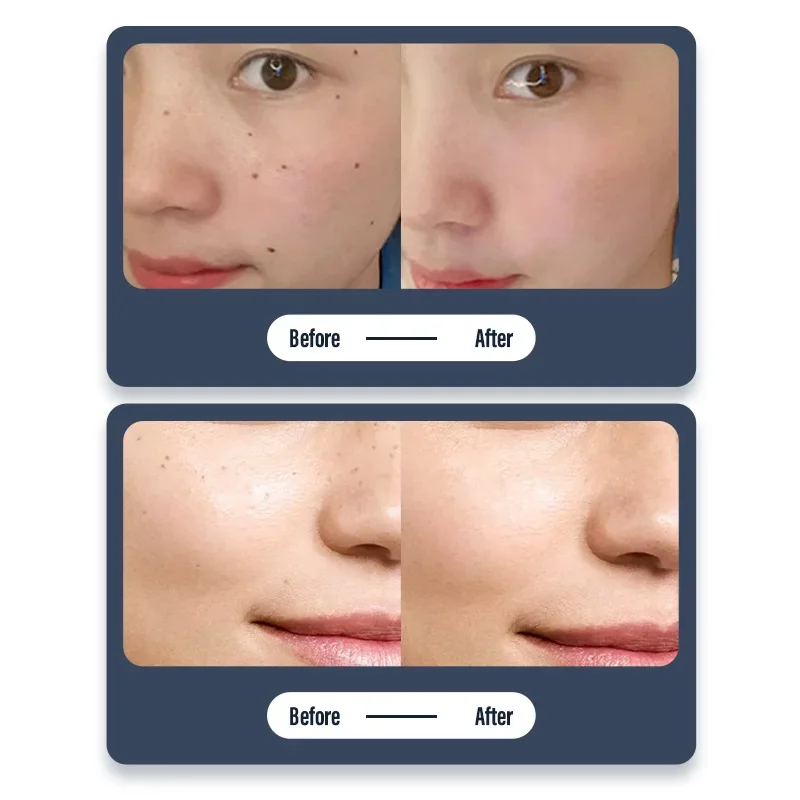 Nieuwe collectie huidoptimalisatie Pen Home Beauty Device voor vrouwen Verwijdering Spot Vermindert huidvlekken Effectief gezichtsverzorgingshulpmiddel
