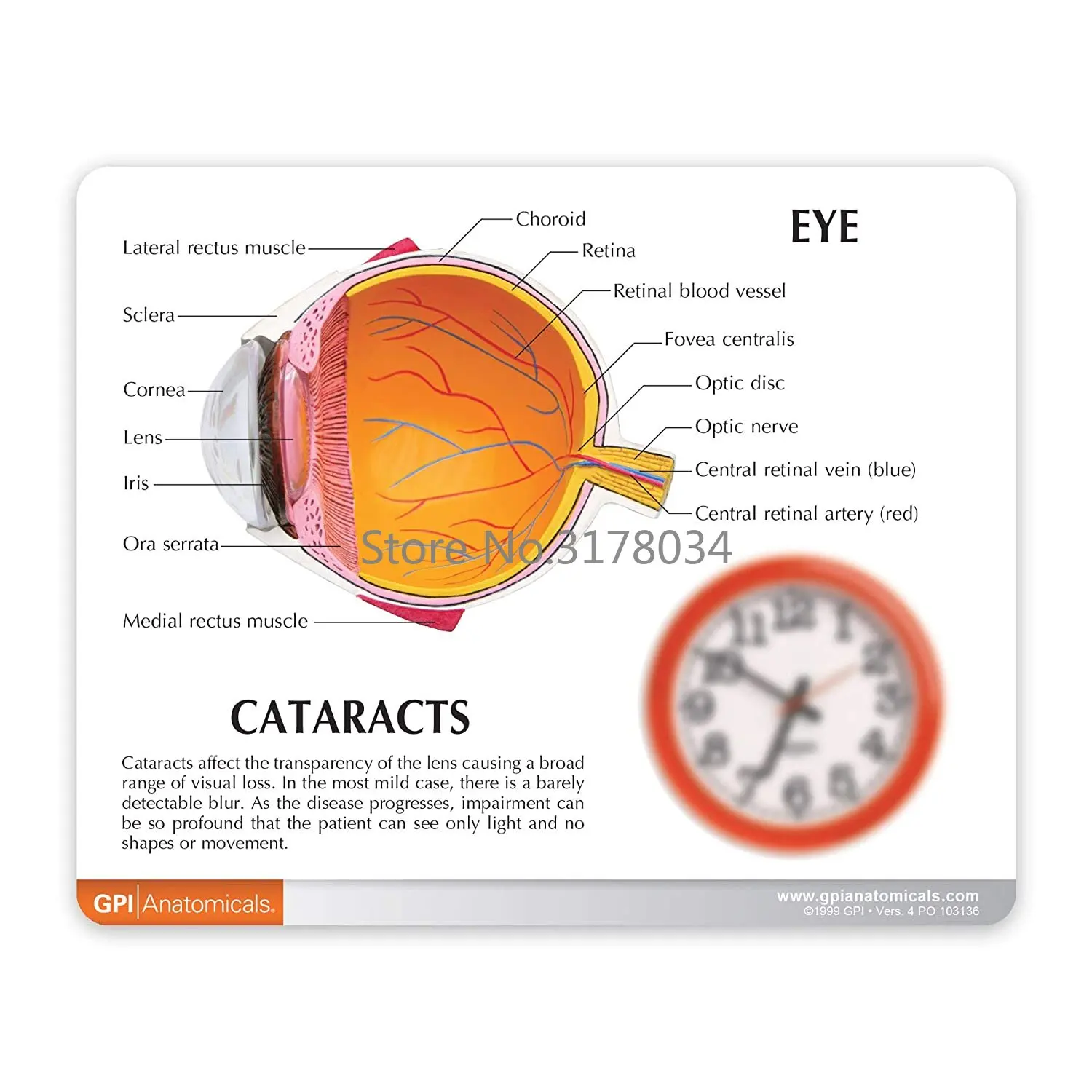 Human Cataract Eye Anatomical Model Body Anatomy Replica of Normal Eye for Doctors Office Educational Tool