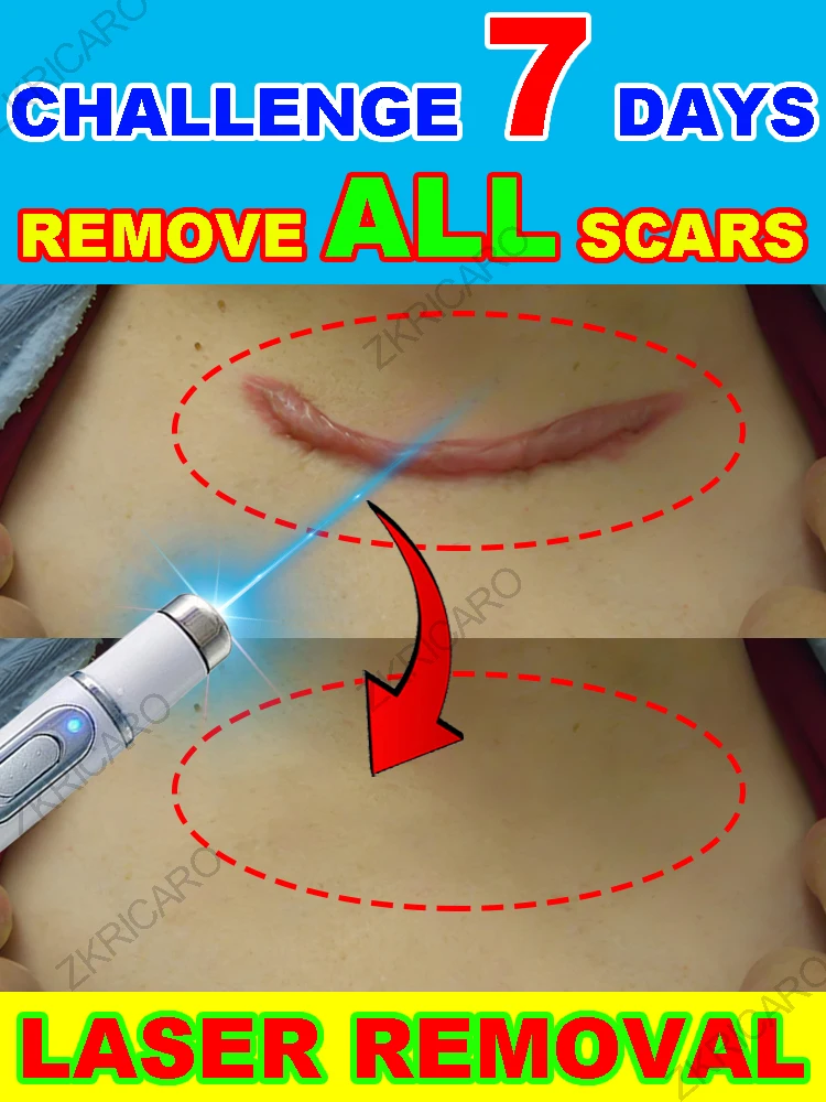 

Laser skin repair, the effect is remarkable, the scars disappeared!