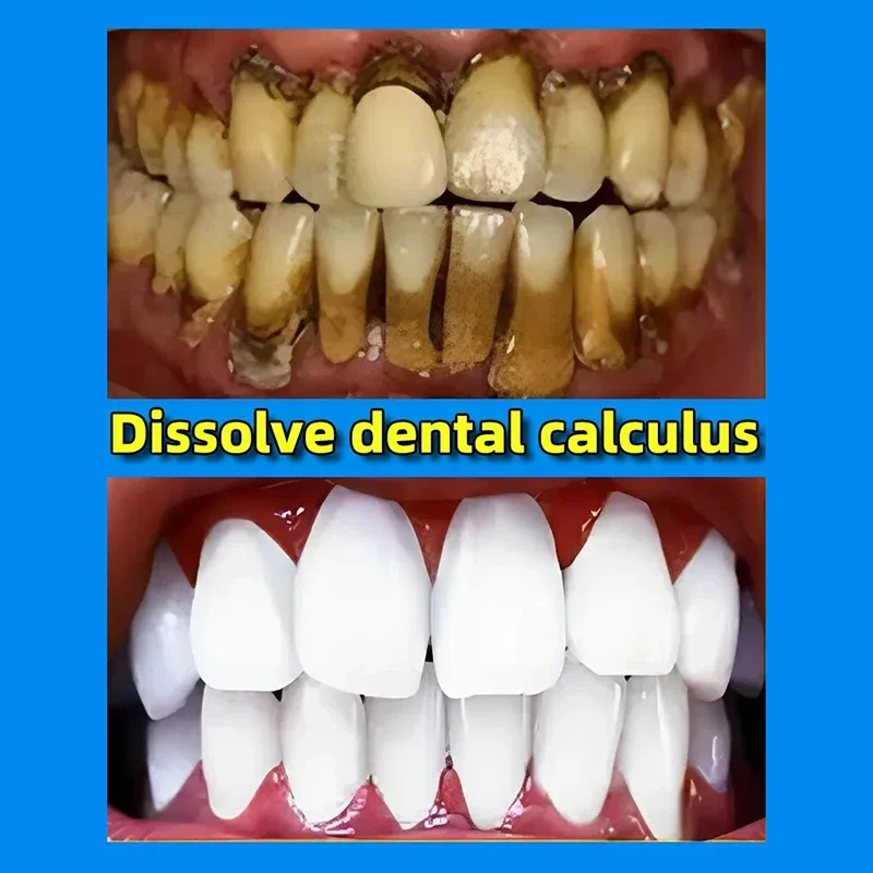 Dentífrico removedor de cálculo dental, remover os dentes amarelos, mau hálito, placa de limpeza, mancha dentária, clareamento, prevenção da periodontite