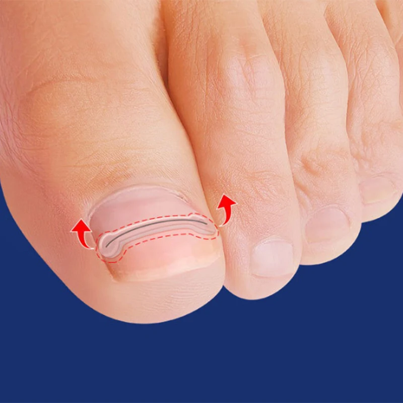 Strumenti per il correttore dell'unghia incarnita Pedicure recuperare il trattamento delle unghie dei piedi incorporati tutore per Clip lisciante per unghie incarnite professionale