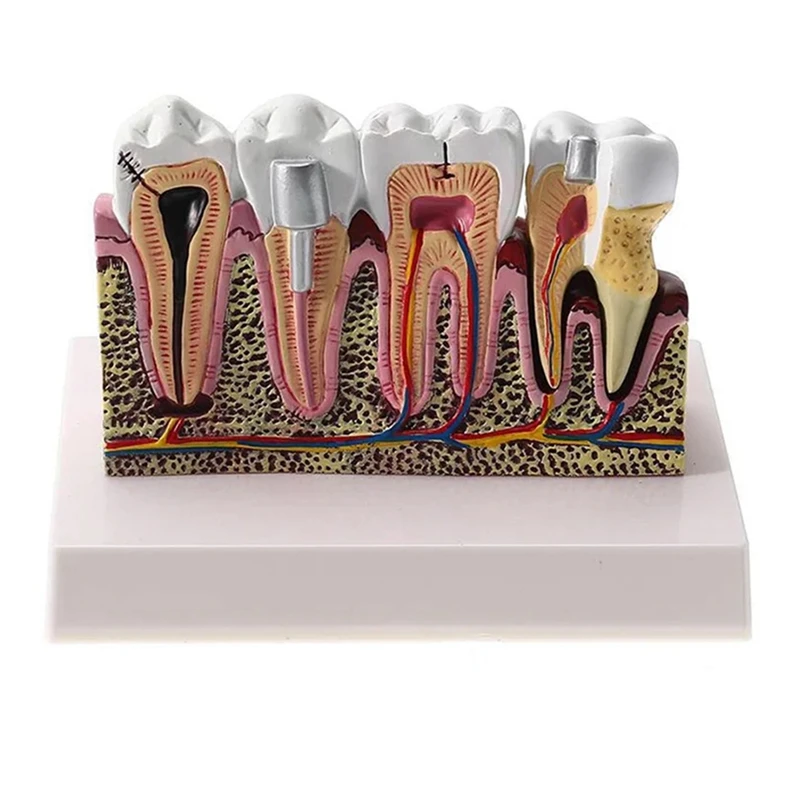 ABNO-Standard  Oral Teeth Anatomical Teaching Model Comprehensive Tooth Structure Model Dentist  Demonstration