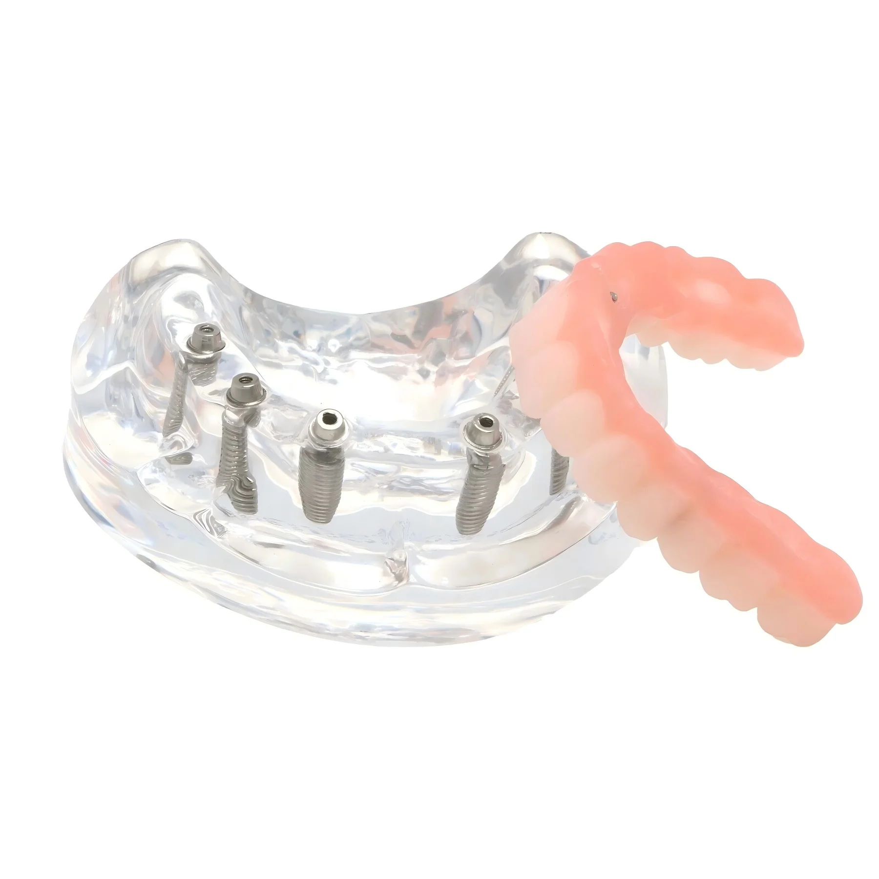 

Restoration Implant Teeth Model With 6 Screws Upper Jaw Post Core Bridges M6001-2