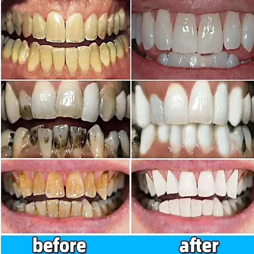 Dental Calculus Remover Teeth Whitening Toothpaste Remove Plaque Stains Prevent Periodontitis Fresh Breath Oral Hygiene Cleaning