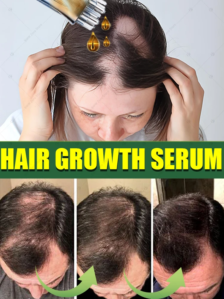 

No te preocupes más con la calvicie, creará el cabello grueso usando este producto.