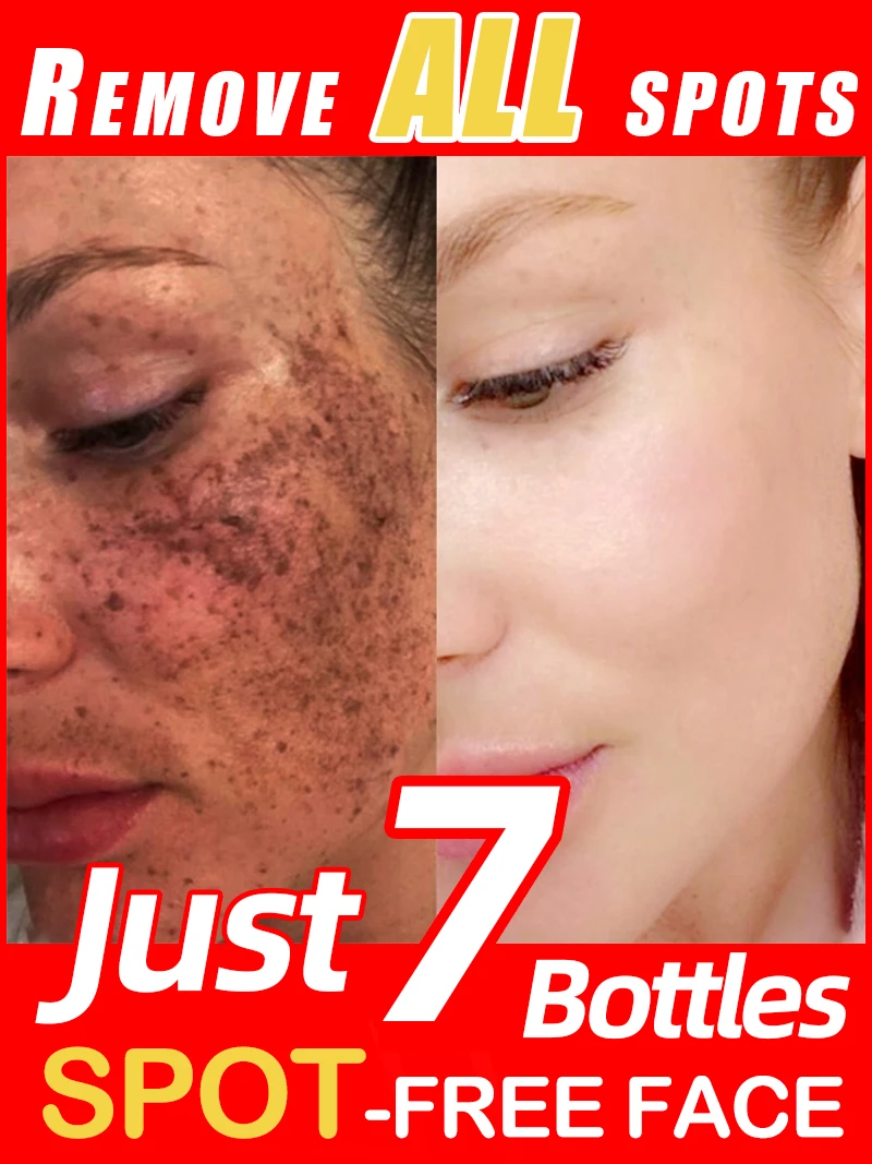 Lighten Freckles Melasma, Facial Dark Spots