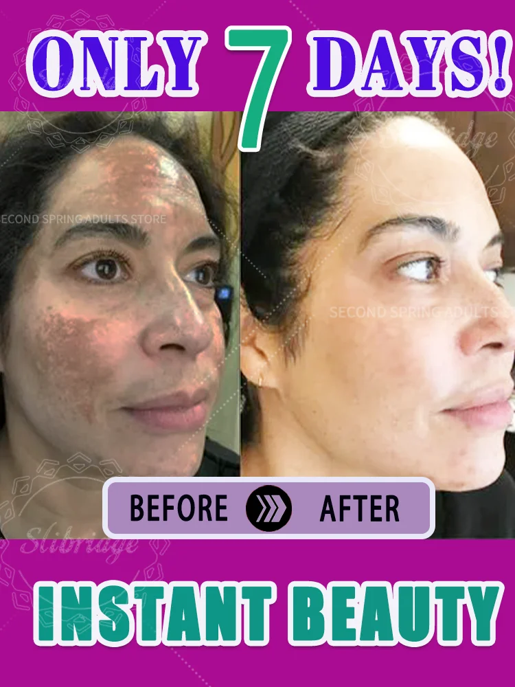 

Remove freckles and whiten the skin, lighten and brighten facial dark spots