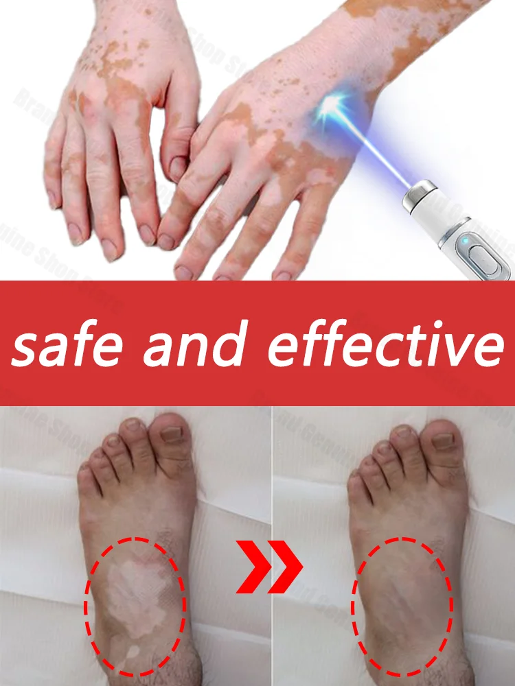 Vitiligo Pen Blue Light Laser