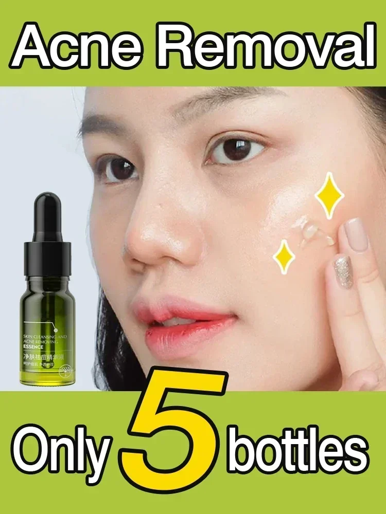 

Acne Removal serum Acne-removing oil Improve Acne Pimple Moisturizer face Repair oil Control Skin Care Products