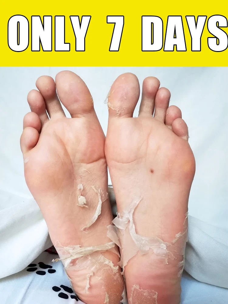 

7-Dᴀʏ Fᴏᴏᴛ Exғᴏʟɪᴀᴛɪɴɢ Sᴘʀᴀʏ, sᴜɪᴛᴀʙʟᴇ ғᴏʀ ᴅʀʏ, ʀᴏᴜɢʜ, ᴄʀᴀᴄᴋᴇᴅ ғᴇᴇᴛ, ʜᴇᴇʟs,