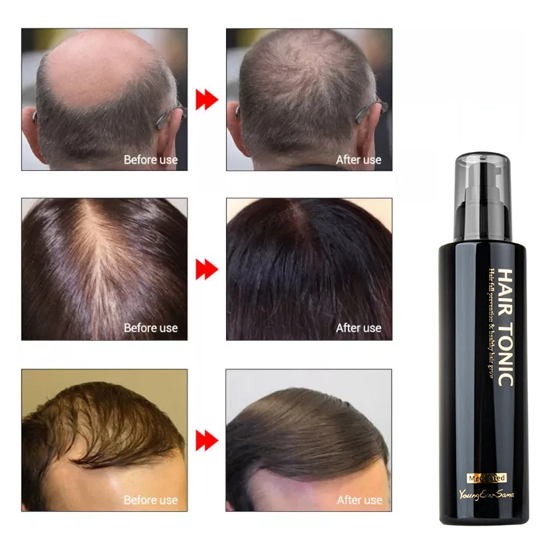 200ml Hair Rich Serum YoungEverSama Hair Enhance Agent Anti-hair Loss Hair Growth Solution Thicken Hairline Essence