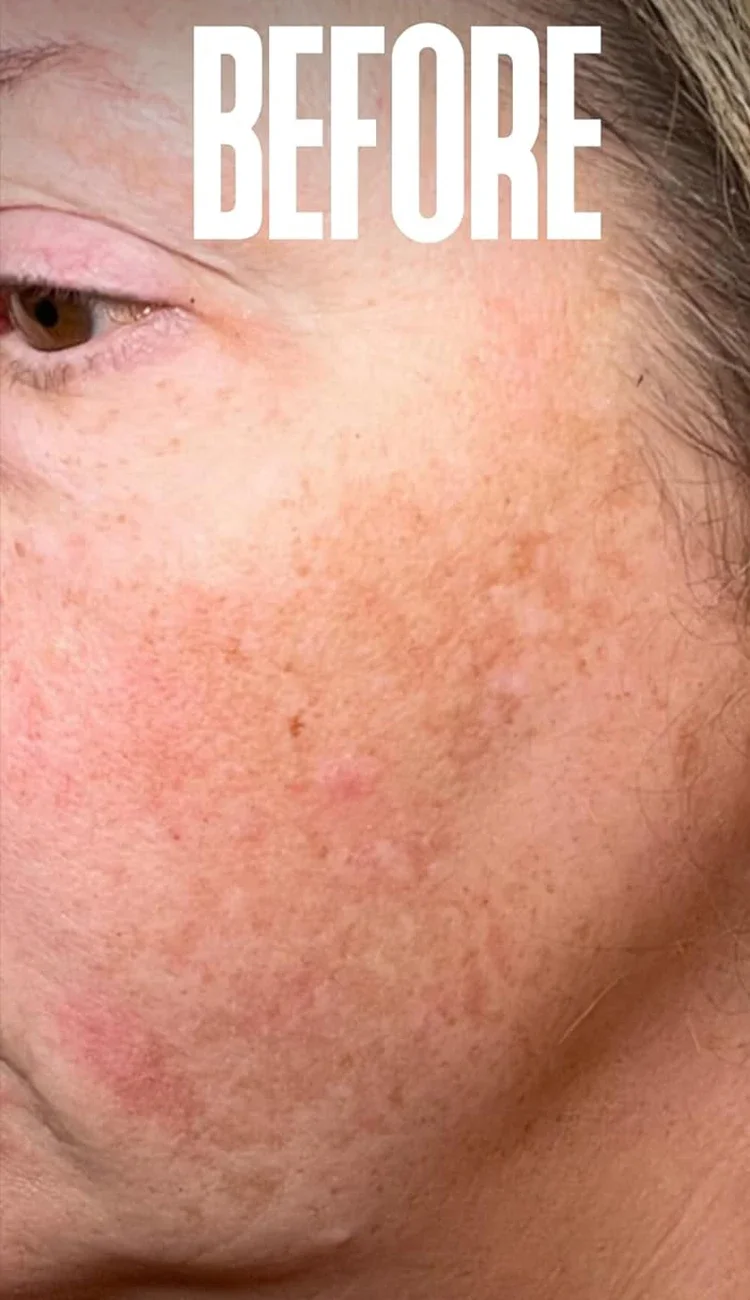 Niacin amid Melasma Aufhellung creme reduzieren Melanin aufhellen Creme aufhellen dunkle Haut Chloasma Serum verblassen feine Gesichts linien