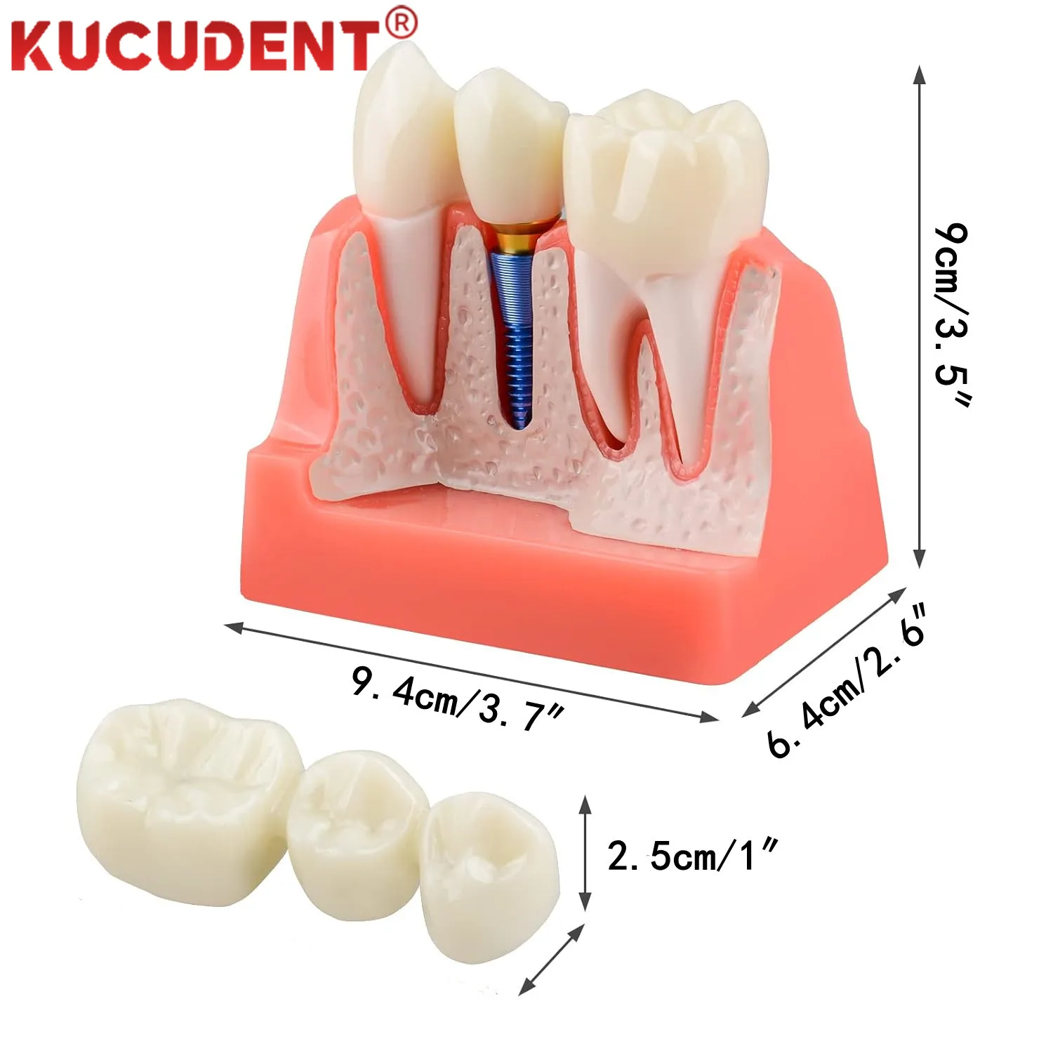 Dental Teeth Implant Model 4/6 Times Caries Comparsion Study Denture Models Analysis Crown Bridge Porcelain Restoration Study