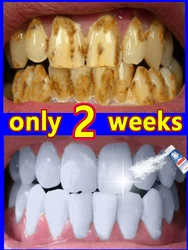 Whitening and cleaning toothpaste, remove tartar, yellow teeth, bad breath and periodontitis in 7 days