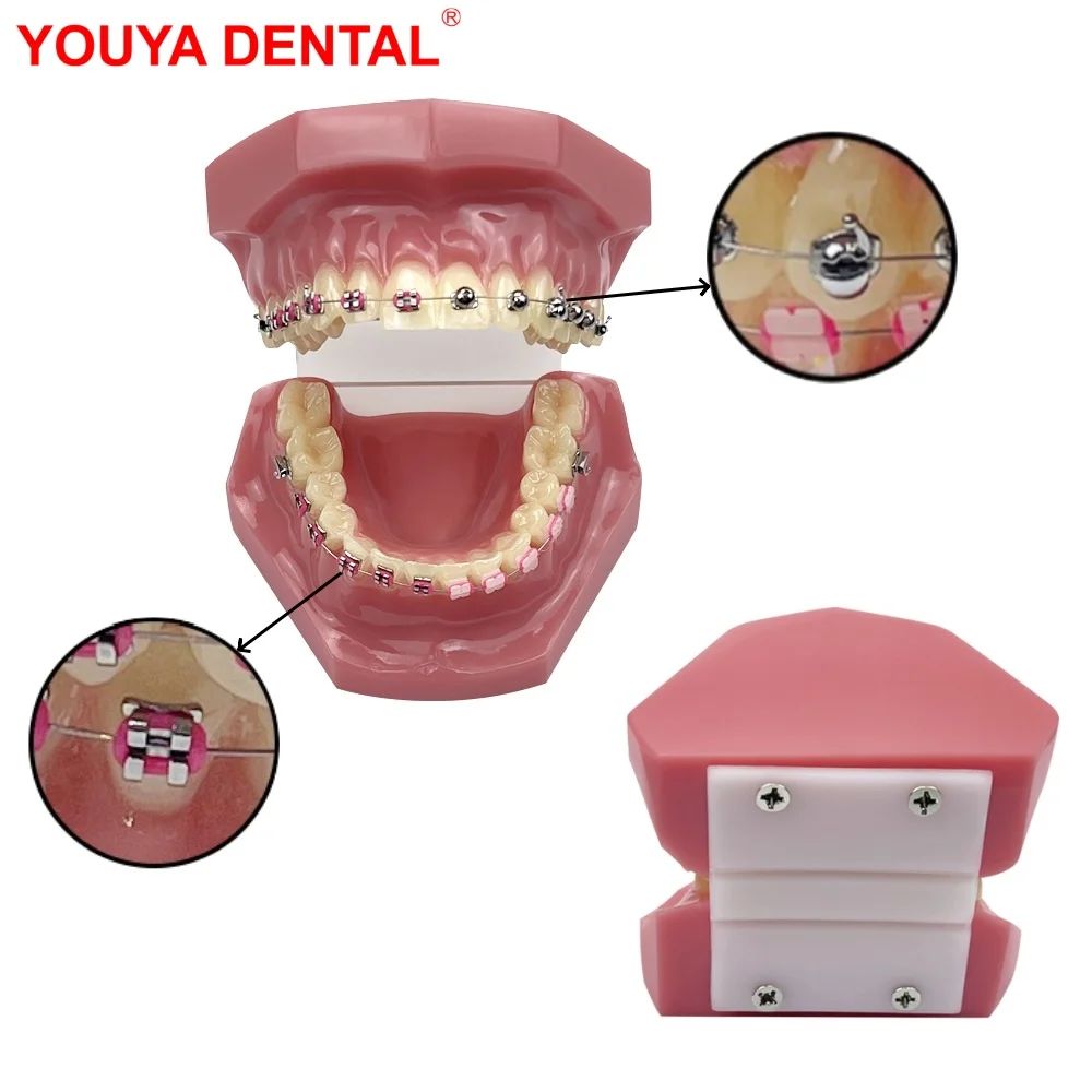 

Dental Teeth Model Orthodontic Model With Brackets 1/4 Spherical Self-Locking For Teaching Studying Dentist-Patient Education