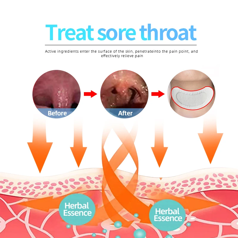Hals schmerzen Behandlung Medizin Pflaster cfda genehmigen trockenen juckenden Hals akute und chronische Pharyngitis Kräuter pflege Patch 6pc/4 Beutel