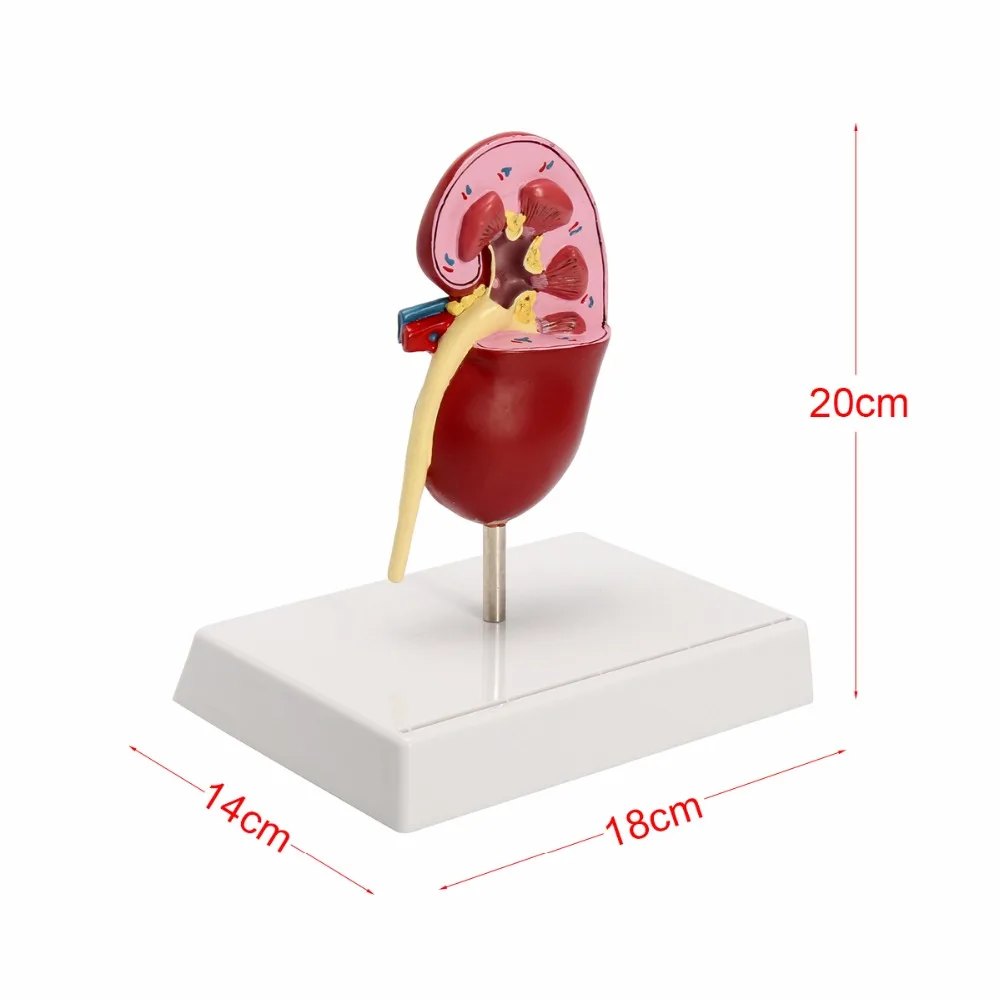 Patologias renais modelo anatomia do corpo humano réplica de rim doente para médicos escritório ferramenta educacional gpi anatômicas