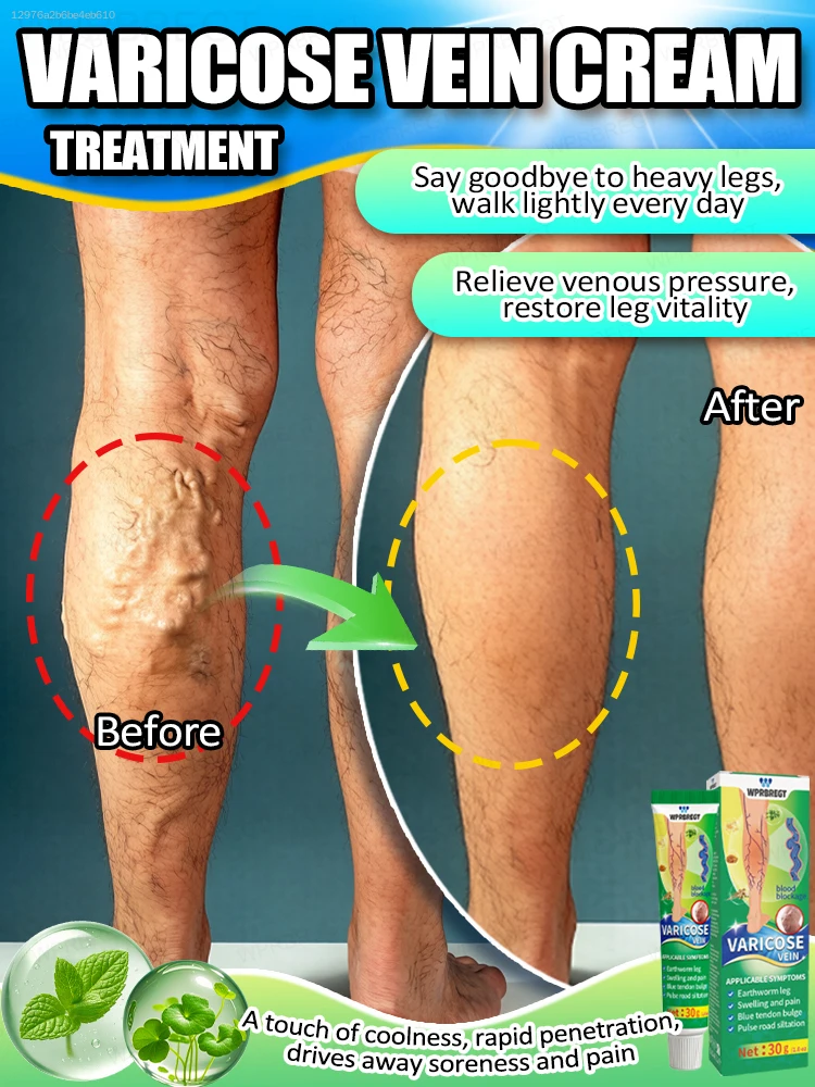 2026 Effective care for ᴠᴀʀɪᴄᴏsᴇ ᴠᴇɪɴs and bulging veins in the legs