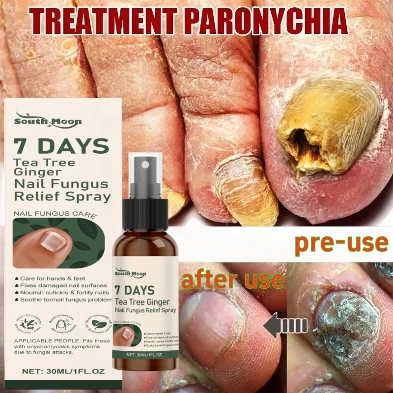 

7Days Nail Fungus Treatment Serum Ginger Anti-infective Paronychia Onychomycosis Toe Foot Nail Fungal Repair Gel Hand Foot Care