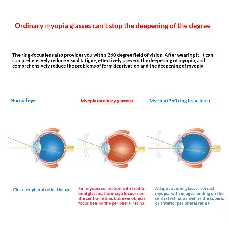 ALICIA 1.56 1.61 1.67 1.74 عدسة مضادة للضوء الأزرق عدسة طبية بصرية CR-39 رجل إمرأة