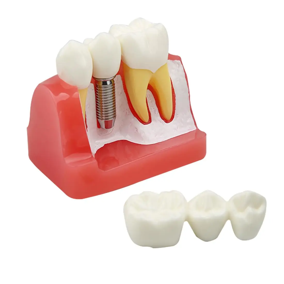 Image 7: Modèle d'implant dentaire AG, pont de couronne amovible, modèle de démonstration de dents 4 fois pour l'enseignement, l'éducation des patients
